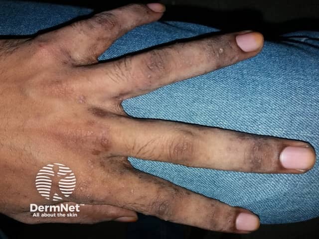 Межпальцевые чесоточные ходы при чесотке