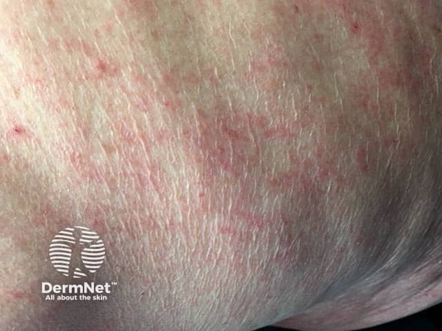 Неспецифическая сыпь при чесотке