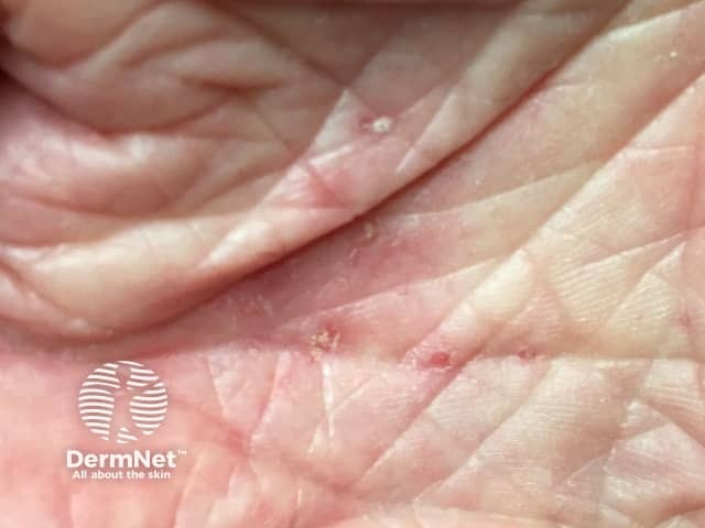 Чесоточные ходы на ладони при чесотке