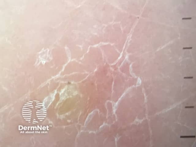 Дерматоскопия чесоточного хода