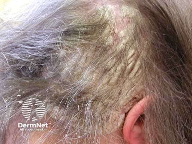 Псориаз волосистой части головы, сопровождающийся диффузным выпадением волос