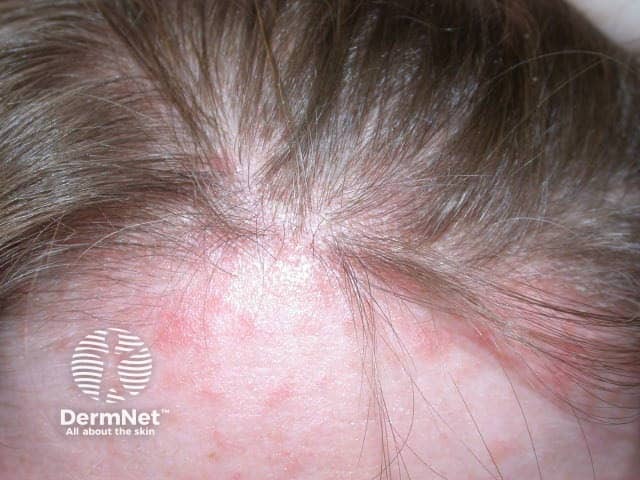 Четко очерченные шелушащиеся псориатические бляшки на коже головы