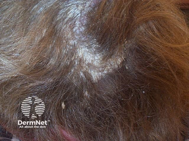 Тяжелый псориаз волосистой части головы и задней поверхности шеи
