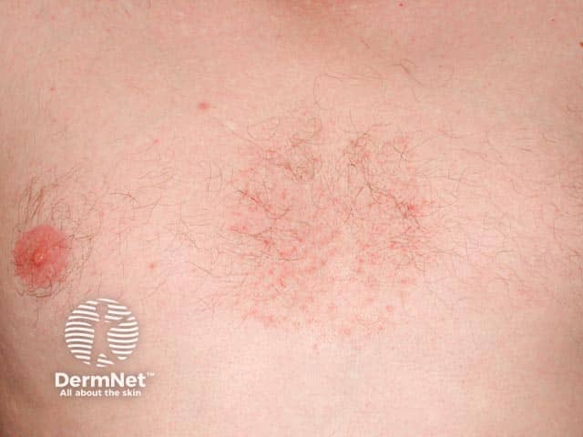 Себорейный дерматит престернальной области и малассезия-фолликулит