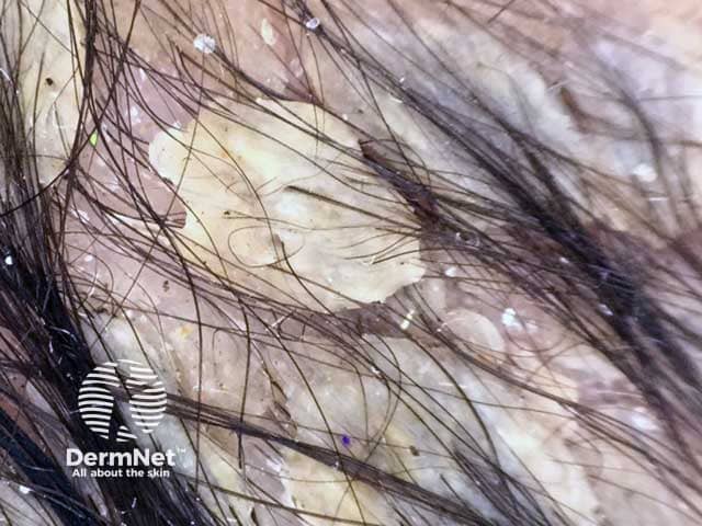 Дерматоскопия волосистой части головы младенца мужского пола: плотно прилегающие желтоватые чешуйки и межфолликулярный сальный секрет