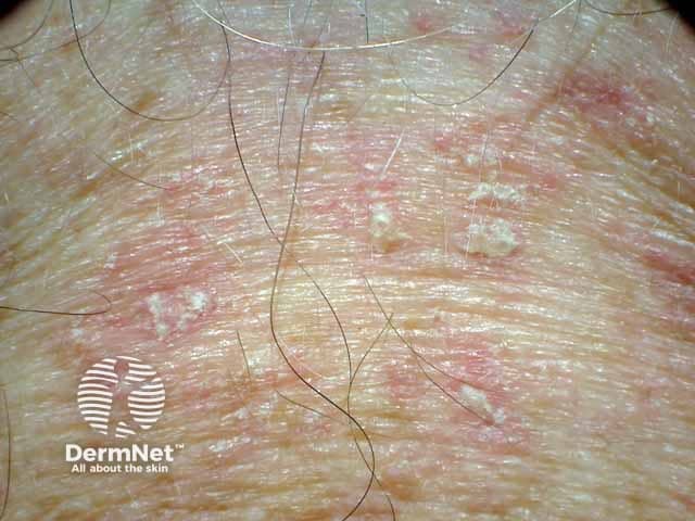 Престернальная эритема и шелушение при себорейном дерматите