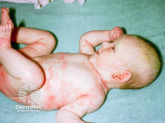 Младенческий себорейный дерматит: экзематозные очаги в пеленочной зоне, подмышечных впадинах и гнейс волосистой части головы
