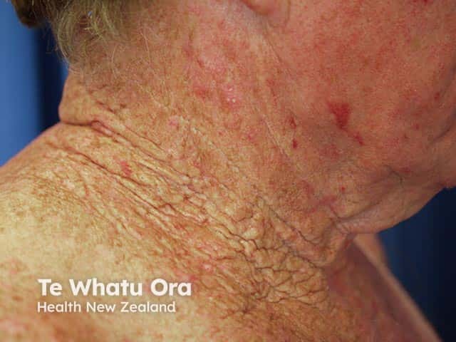 Грубые морщины и бугристые желтоватые очаги при выраженном солнечном эластозе