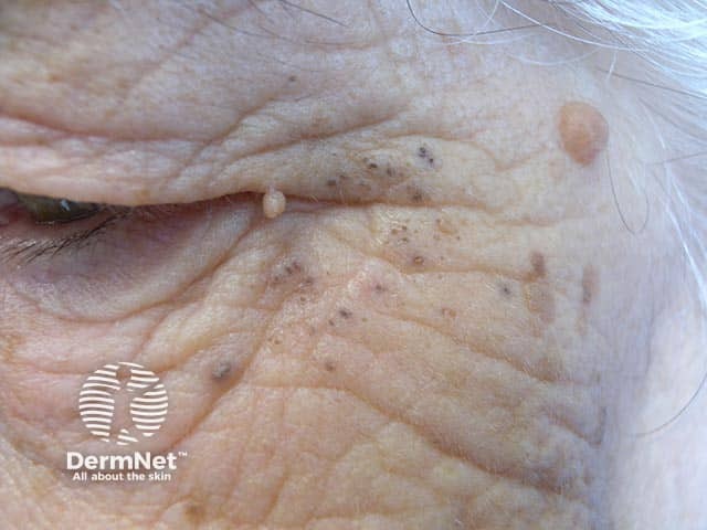 Грубые морщины и актинические комедоны в верхней части щеки