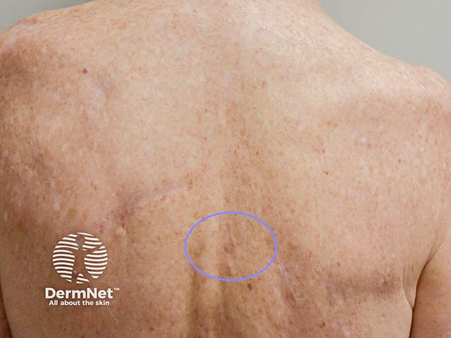 Гипомеланотическое пятно в межлопаточной области спины; при эксцизии выявлена тонкая поверхностно-распространяющаяся меланома