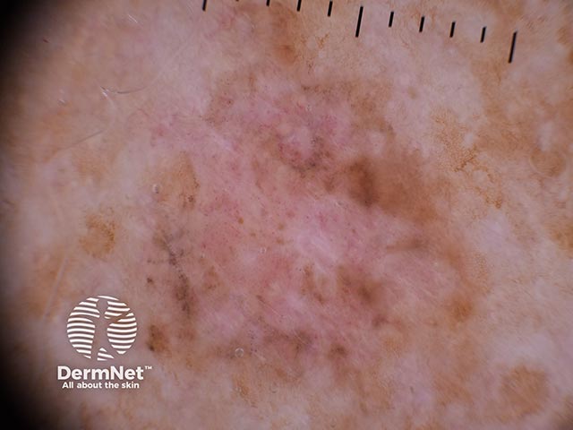 Дерматоскопия гипомеланотической поверхностно-распространяющейся меланомы: неровный край, атипичные сосуды и неравномерно расположенные серые точки