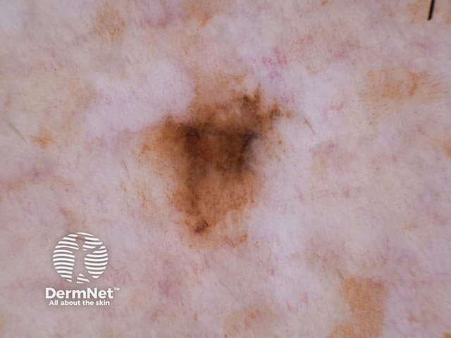 Меланома in situ: неровные края, неравномерная пигментация и периферические бесструктурные зоны