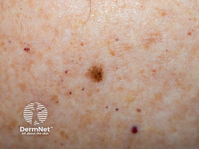 Поверхностно-распространяющаяся меланома кожи спины у пациента с меланомой в анамнезе