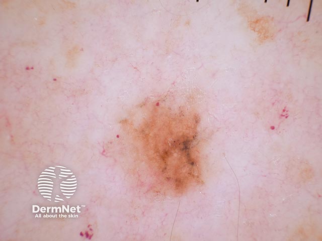 Поверхностно-распространяющаяся меланома кожи спины с наличием атипичных серых точек