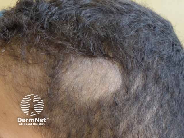 Шелушащийся очаг с короткими обломанными волосами при микозе волосистой части головы.