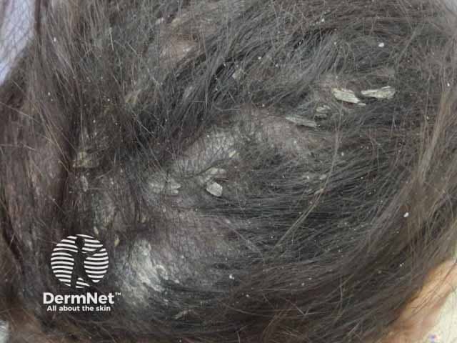Выраженное шелушение и поредение волос волосистой части головы при микозе.
