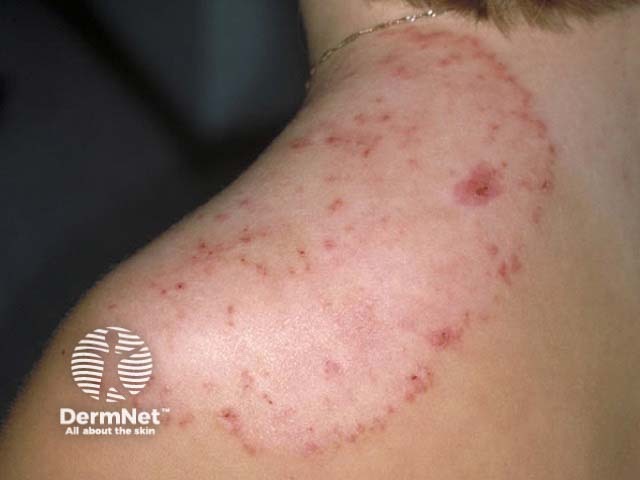 Микоз гладкой кожи (tinea corporis)