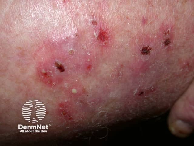 Папулезные и пустулезные элементы по периферии очага микоза гладкой кожи