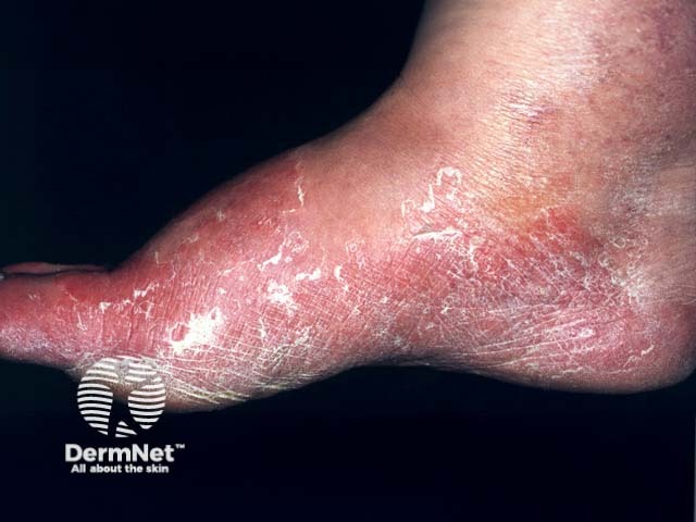 Микоз стоп (tinea pedis)