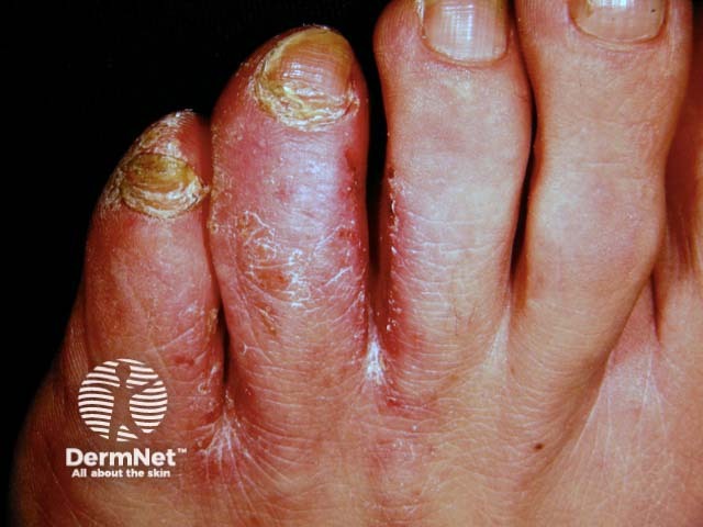 Микоз стоп (tinea pedis)
