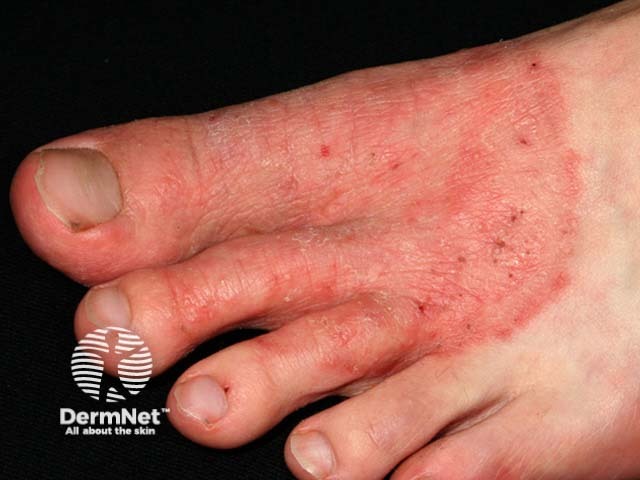 Микоз стоп (tinea pedis)