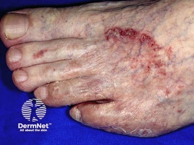 Микоз стоп (tinea pedis)