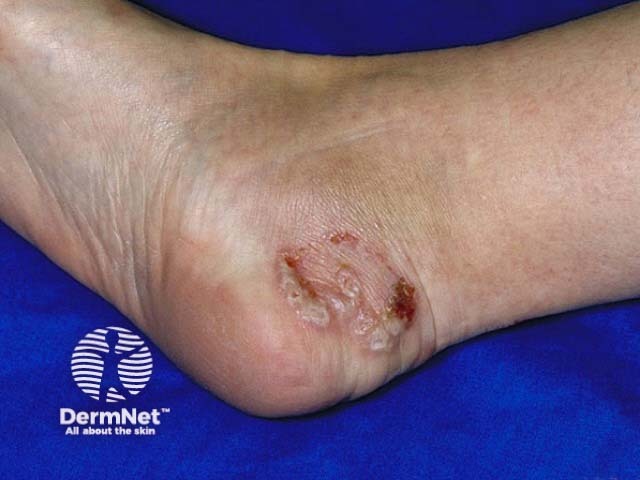 Микоз стоп (tinea pedis)