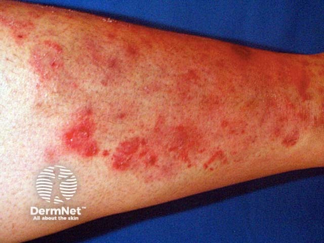Tinea incognita (стертая клиническая картина дерматофитии)