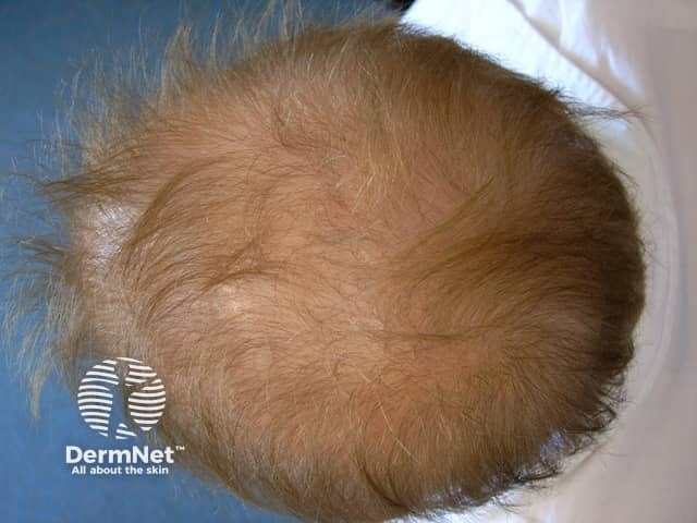 Диффузная алопеция на фоне приема ацитретина