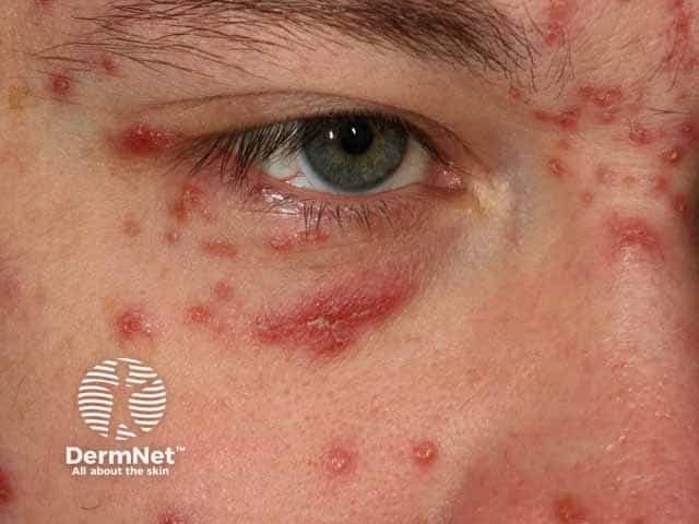 Папулезные элементы acne agminata в периорбитальной зоне и на веках