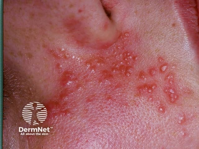 Клиническая картина acne agminata: красновато-коричневые диссеминированные папулы