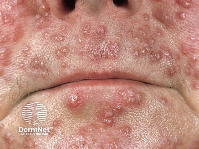 Acne agminata (сгруппированные угри)