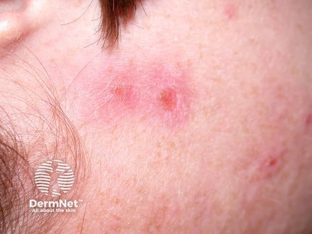 Экскориированные угри с признаками вторичной механической травматизации