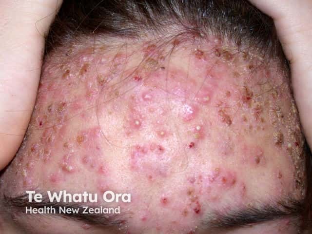 Молниеносные угри (acne fulminans)
