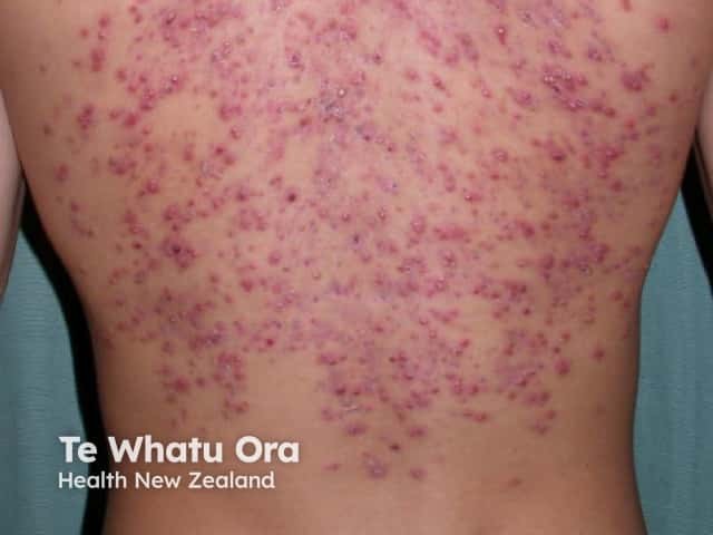 Молниеносные угри (acne fulminans)