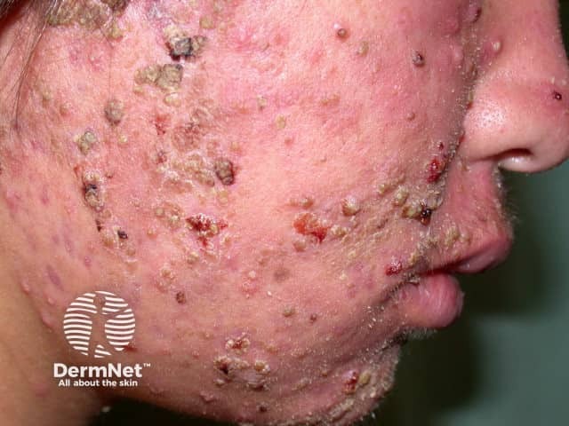 Молниеносные угри (acne fulminans)