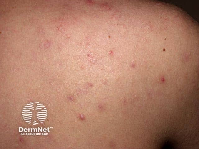 Активные воспалительные элементы акне в сочетании с перифолликулярным эластолизом и признаками застарелых экскориаций на спине