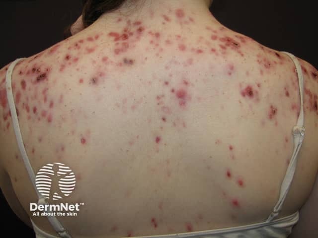 Угревая сыпь в области спины: комедоны и воспалительные инфильтраты