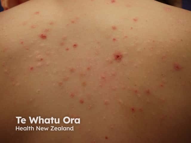 Уртикарные угри (acne urticata): эритематозные папулы и экскориации