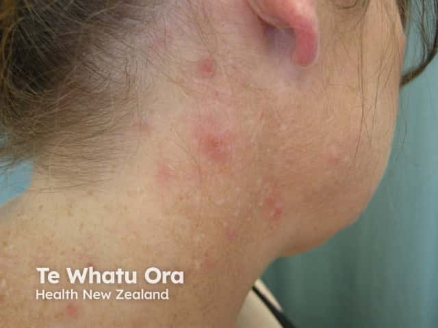 Уртикарные угри (acne urticata): клиническая картина в верхней части туловища