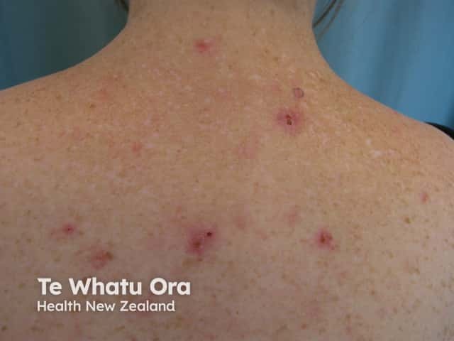 Уртикарные угри (acne urticata): множественные расчесанные элементы с корками