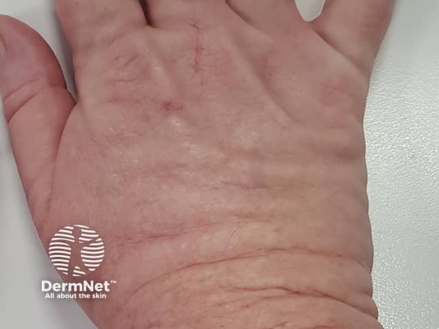 Акральный персистирующий папулезный муциноз: клиническая картина поражения кожи в области лучезапястного сустава и предплечья