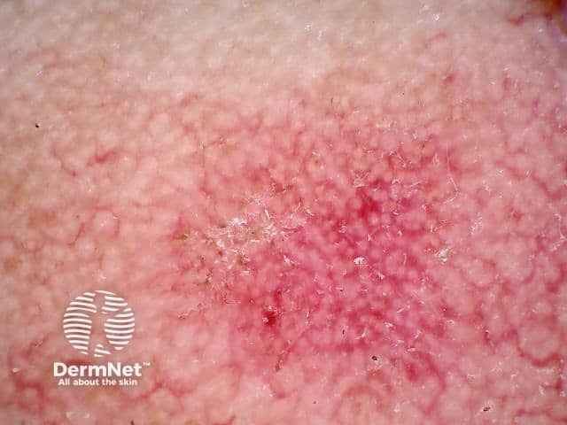 Дерматоскопия актинического кератоза лица: симптом «клубники» (strawberry pattern)