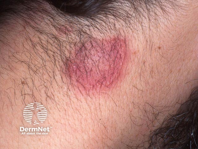 Кольцевидная бляшка на шее при остром фебрильном нейтрофильном дерматозе: определяется псевдовезикулезный край