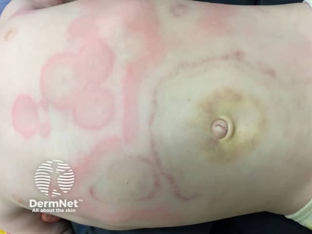 Болезнь Финкельштейна (острый геморрагический отек детей раннего возраста)