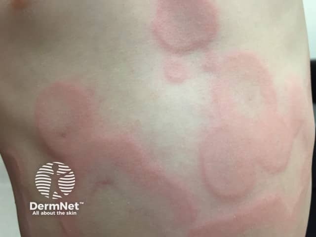 Болезнь Финкельштейна (острый геморрагический отек детей раннего возраста)