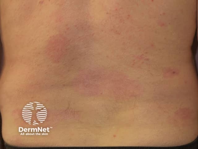 Псориаз через 6 месяцев после начала применения адалимумаба