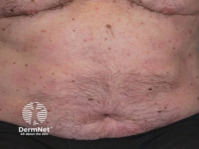 Псориаз через 6 месяцев после начала применения адалимумаба