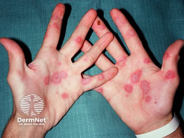 Нежелательная кожная реакция на антиконвульсант: мишеневидные очаги многоформной эритемы