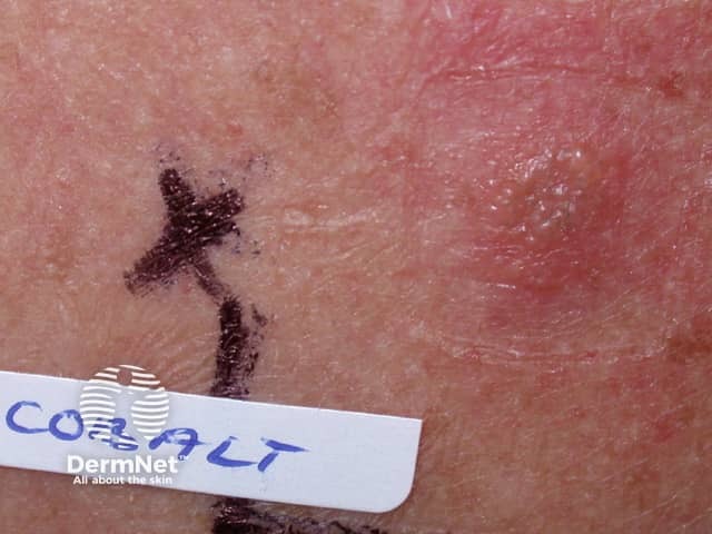 Положительная реакция при аппликационном тестировании (патч-тесте) с хлоридом кобальта (эритема и папулезный инфильтрат)